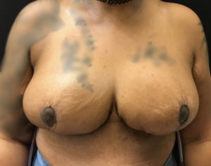 Breast Reduction