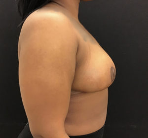 Breast Reduction