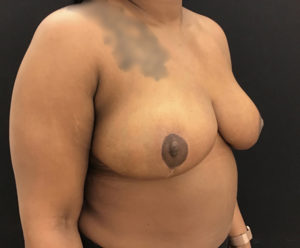 Breast Reduction