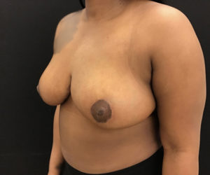 Breast Reduction