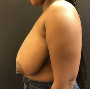 Breast Reduction