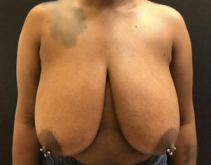 Breast Reduction