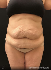 Tummy Tuck