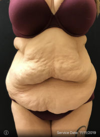 Tummy Tuck