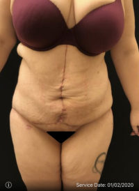 Tummy Tuck