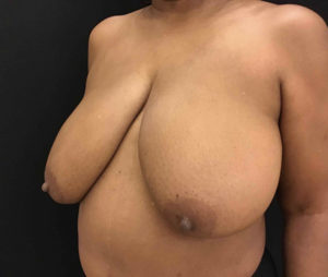Breast Reduction