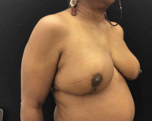 Breast Reduction