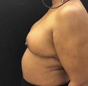Breast Reduction