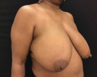 Breast Reduction