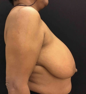 Breast Reduction