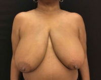 Breast Reduction