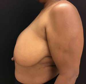 Breast Reduction