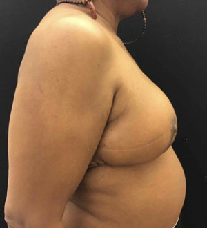 Breast Reduction