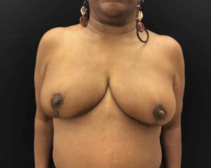 Breast Reduction