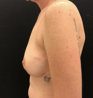 Breast Reconstruction