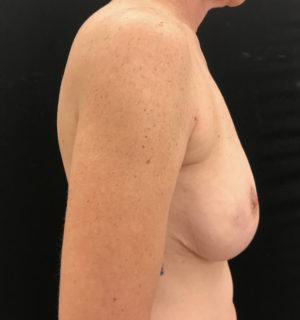 Breast Reconstruction