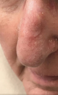 Basal Cell Carcinoma