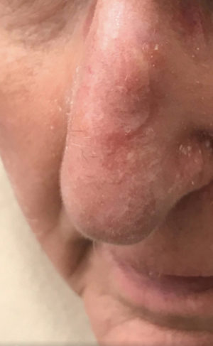 Basal Cell Carcinoma
