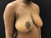 Breast Reduction