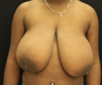 Breast Reduction