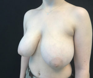 Breast Reduction