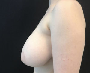Breast Reduction