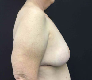 Breast Reduction