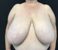 Breast Reduction