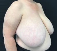 Breast Reduction