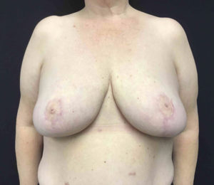 Breast Reduction
