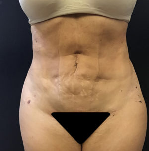 Liposuction