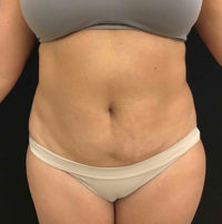 Liposuction