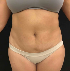 Liposuction