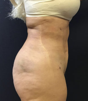 Liposuction