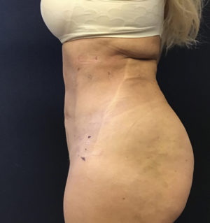 Liposuction