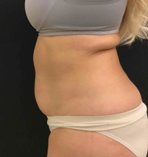 Liposuction