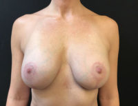 Breast Lift