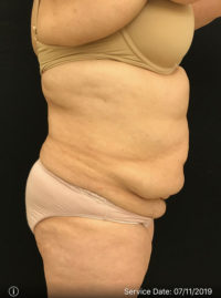 Tummy Tuck