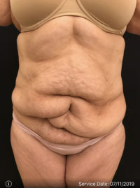 Tummy Tuck