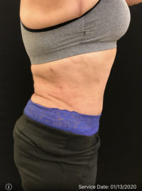 Tummy Tuck