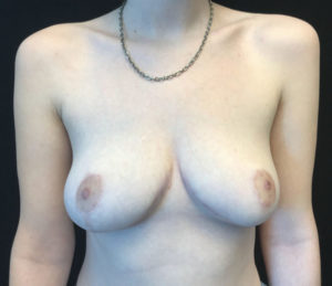 Breast Reduction