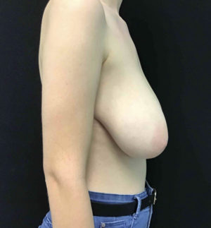 Breast Reduction