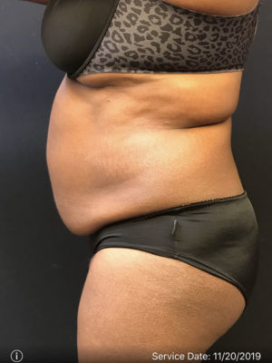 Liposuction