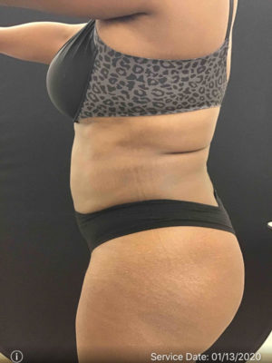 Liposuction
