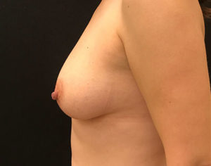 Breast Reconstruction