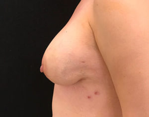 Breast Reconstruction