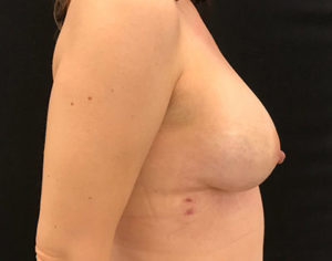 Breast Reconstruction