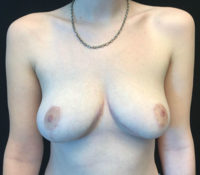 Breast Reduction