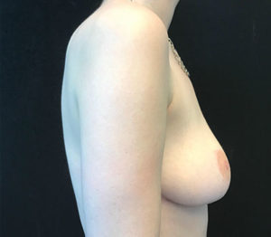 Breast Reduction