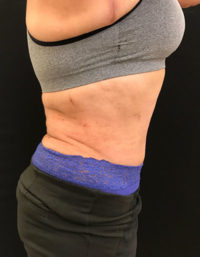 Tummy Tuck